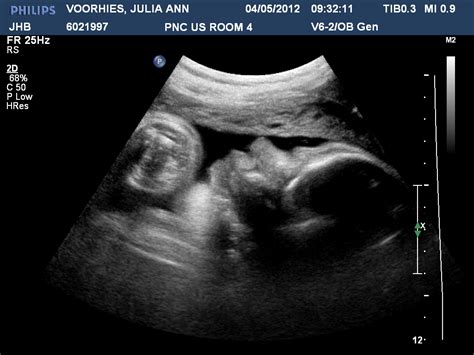 Baby Voorhies 38 Week Ultrasound