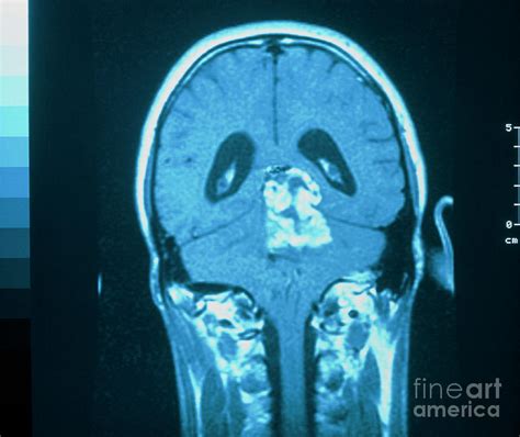 Mri Scan Of Brain Tumour Cerebellar Glioma Photograph By Simon Fraser