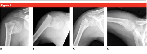 Pediatric Proximal Humerus Fractures Musculoskeletal Key My Xxx Hot Girl