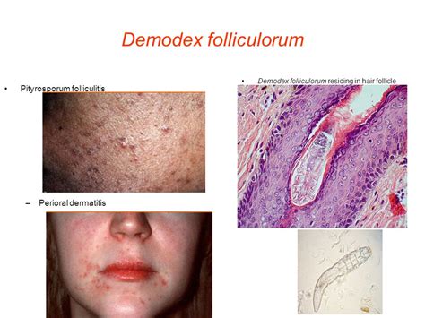 25 Best Demodex Folliculitis Treatment Demodectic Mange