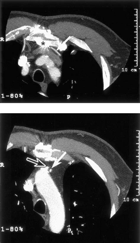 Modification Of Surgical Planning Based On Cardiac Multidetector