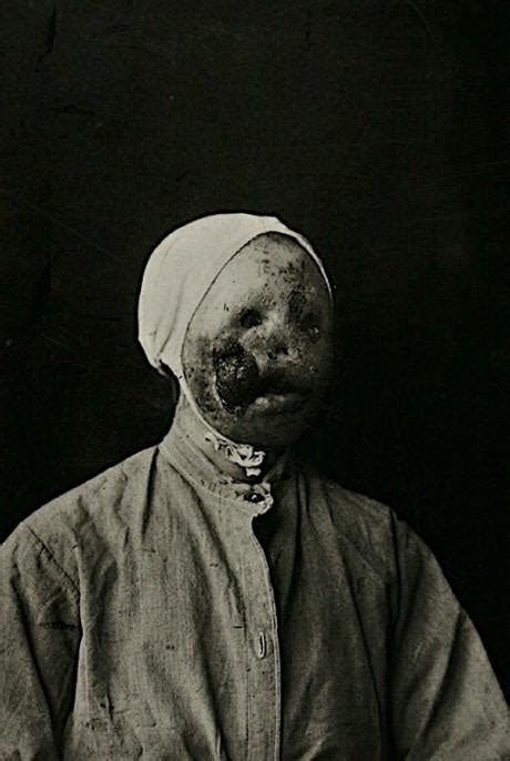 So the best way to know if syphilis is sneaky, because you or your partner may not have any symptoms that you see or feel. Effects of Syphilis before penicillin : creepy