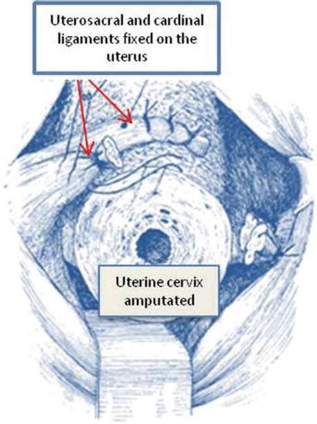 Uterosacral Ligament Plication