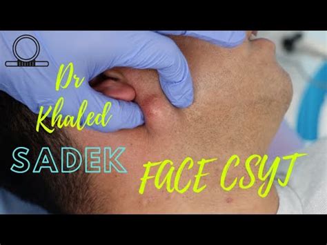 Face Cyst Removal Dr Khaled Sadek Lipomacyst Com Youtube