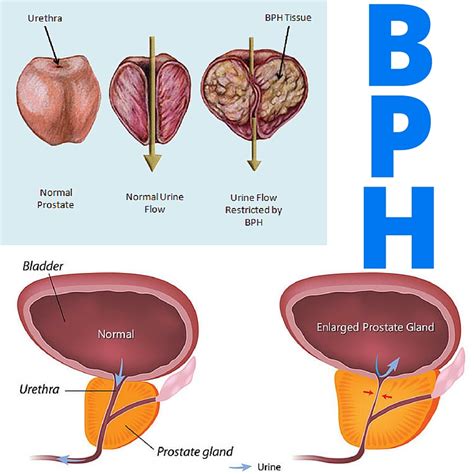 Bph Symptom Score Index Ii Basic Principles Benign Prostatic Hyperplasia Bph Aua