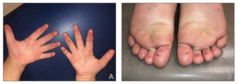 Not Covid Toes Pool Palms And Feet In Pediatric Patients Mdedge