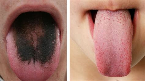 Black Hairy Tongue Is Real And It Looks As Weird As It Sounds