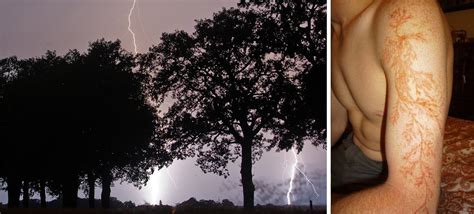 What Its Like To Be Struck By Lightning And Survive