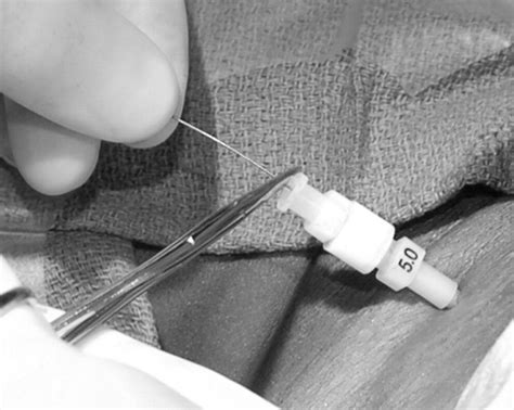 Principles Of Tunneled Cuffed Catheter Placement Techniques In