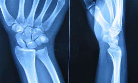 Madelung Deformity Causes And Treatment Bone And Spine