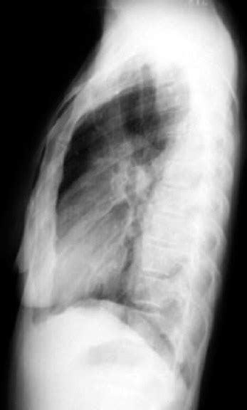 Pleural effusion (transudate or exudate) is an accumulation of fluid in the chest or on the lung. Dark lung fields