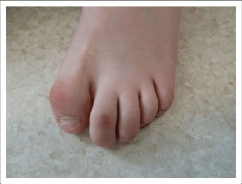 Feet Demonstrating Hypoplastic Nails Bulbous Tips Underriding Fourth