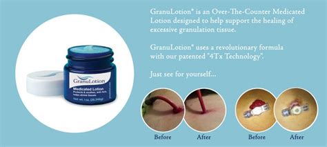 Granulotion Otc Medicated Lotion Helps Shrink Tissues Supports