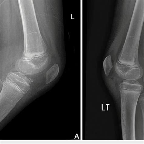 A Showing A Lateral X Ray Of The Left Knee Preoperatively Reveals A