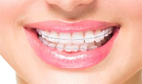 We did not find results for: How Can I Straighten My Teeth? Straightening Options And ...