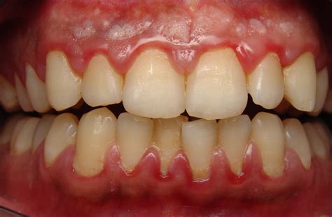 Gum Disease Signs And Treatment In Mesa Top Rated Cosmetic General