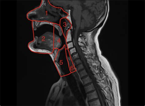 Imaging In Head And Neck Cancers Bja Education