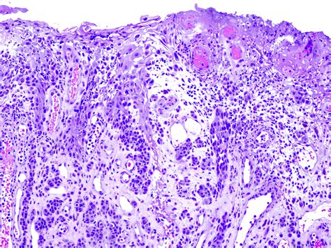 Pathology Outlines Acral Melanoma
