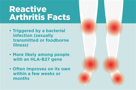 What Is Reactive Arthritis Understanding Symptoms Causes And Treatment