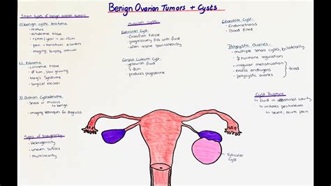 Benign Ovarian Cyst Types Hot Sex Picture