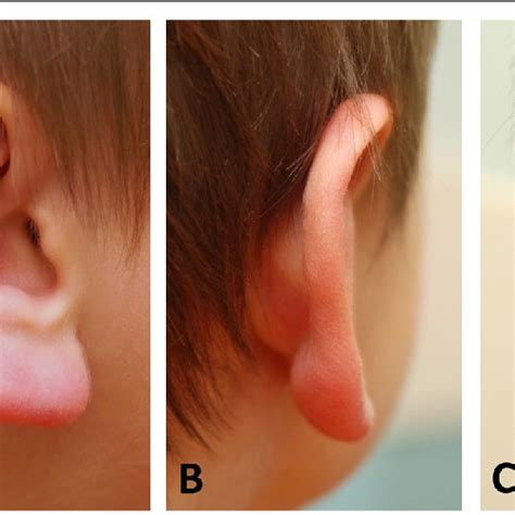 Pdf A Painless Erythematous Swelling Of The External Ear As A