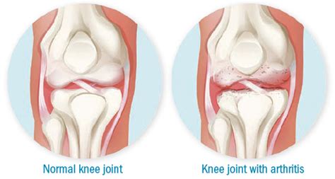 It reduces the ability to move freely and impacts the quality of life. Low Impact Exercises For Knee Arthritis - 6 Knee ...