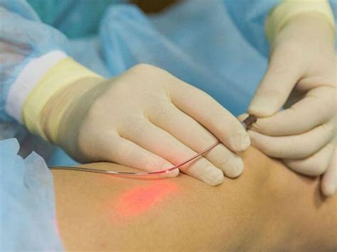 Laser Leg Vein Removal New Skin Laser Clinic