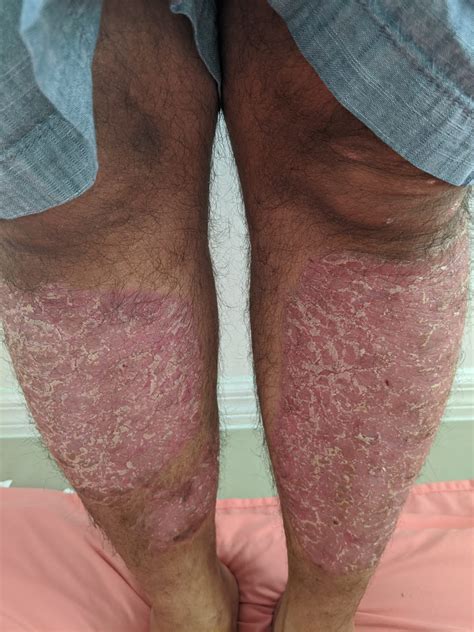 Guttate Psoriasis Before And After Photos Skin Cure Now