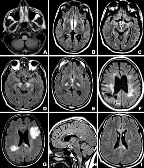 Figure Brain Lesion Distribution In Our Patients With Neuromyelitis