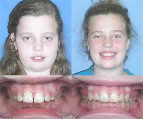 Overbite Before And After Braces Top Pictures And More 2022 Bracesboss