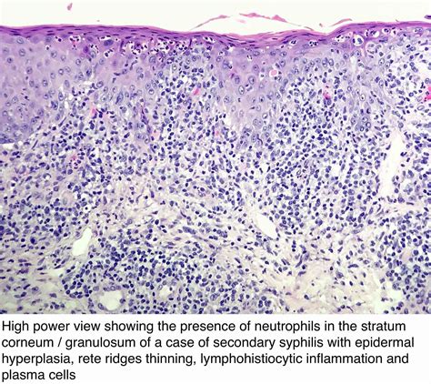 Pathology Outlines Syphilis