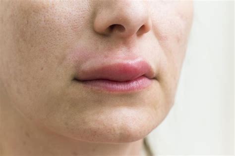 Bump On Lip Causes Treatment And When To See A Doctor Swollen Lips