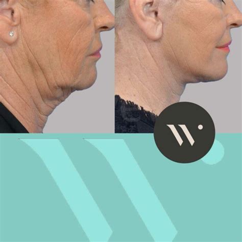 Face And Neck Lift 11 Dr Wever Internationaal Topspecialist