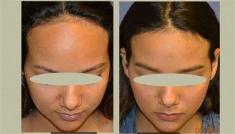 Lower Your Hairline With A Surgical Procedure Forehead Reduction