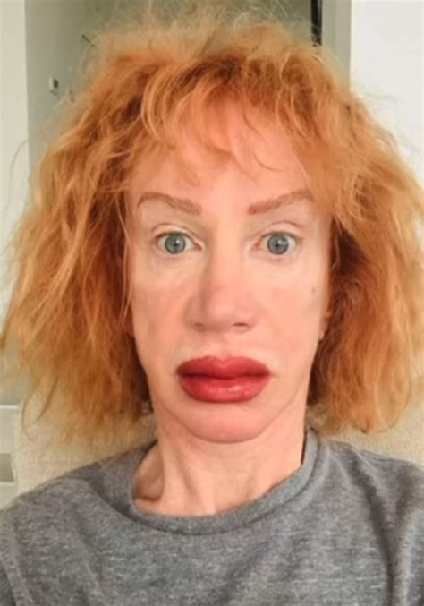 Comedian Reveals Results Of New Lip Procedure Reality Stars Before And