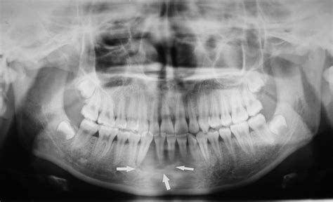 Gingival Squamous Cell Carcinoma In Young Patients Report Of A Case