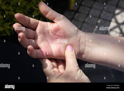 Severe Allergic Eczema On The Hands Red Cracked Skin With Blisters
