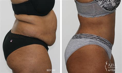 For me, my belly just happened to cross way into that line where i felt deformed and it was making me unhappy. Insider's Guide: Tummy Tuck Tips | Abdominoplasty Tips