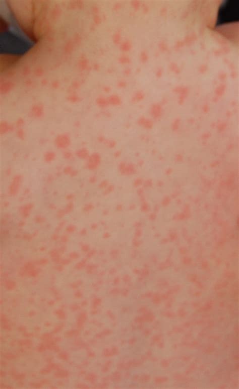 Amoxicillin Rash Pictures Causes Symptoms Precautions And Treatment