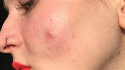 Cyst On Face Sebaceous Wont Pop Infected Under Skin Head