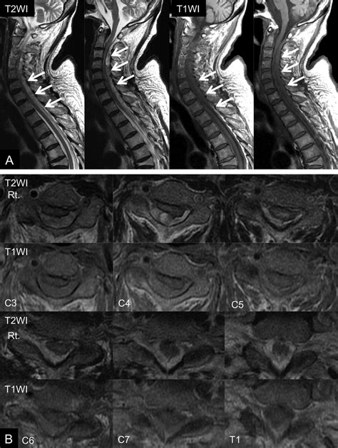 Cervical Mri At The Time Of Deterioration To Tetraplegia A Sagittal