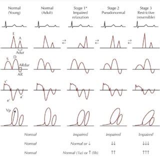 Stages Of Diastolic Function The Doppler Echocardiography Measures