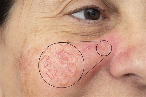 Broken Capillaries Cause And Treatment Ask A Dermatologist