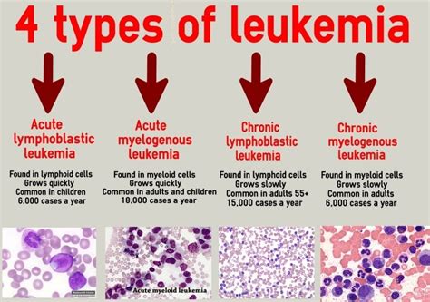 Types Of Leukemia Overview Diagnosis Cancer Stages And Treatment