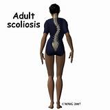 Images of Exercises For Scoliosis Adults
