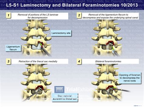 L5 S1 Laminectomy And Bilateral Foraminotomies Trial Exhibits I