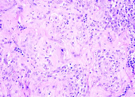 Myxoinflammatory Fibroblastic Sarcoma ×400 Note The Large Atypical