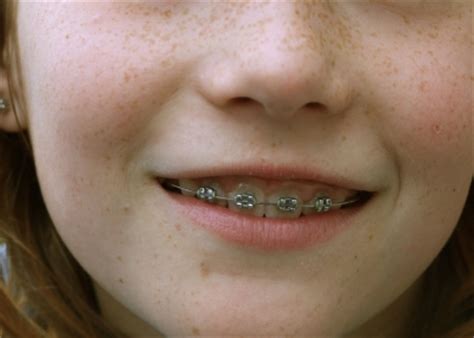 Feste zahnspangen sorgen für ein strahlendes lächeln und optimalen biss. Zahnspange: fest oder herausnehmbar? | apotheken-wissen.de