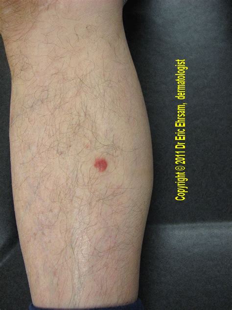 Dermoscopy A Red Tumor On A Leg 3dc