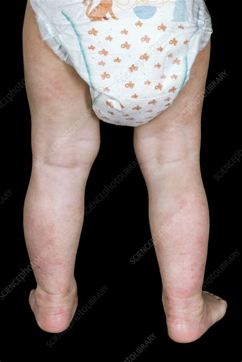 Atopic Eczema On A Babys Legs Stock Image C0389474 Science